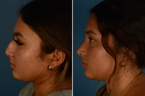 Rhinoplasty Before and After Photos in Naples, FL, Patient 33419