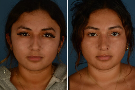 Rhinoplasty Before and After Photos in Naples, FL, Patient 33419