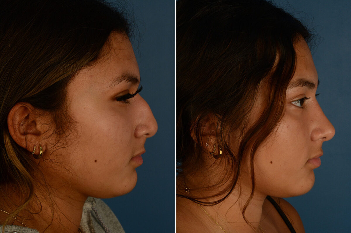 Rhinoplasty Before and After Photos in Naples, FL, Patient 33419