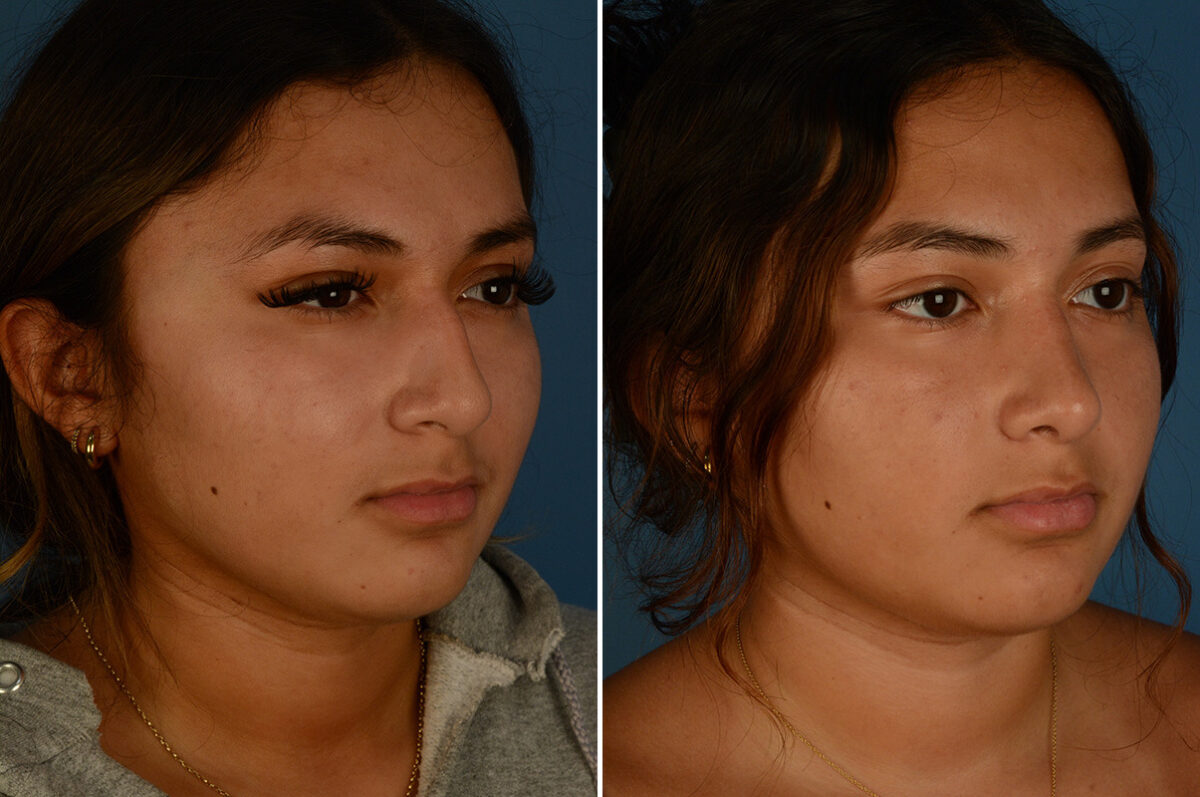 Rhinoplasty Before and After Photos in Naples, FL, Patient 33419