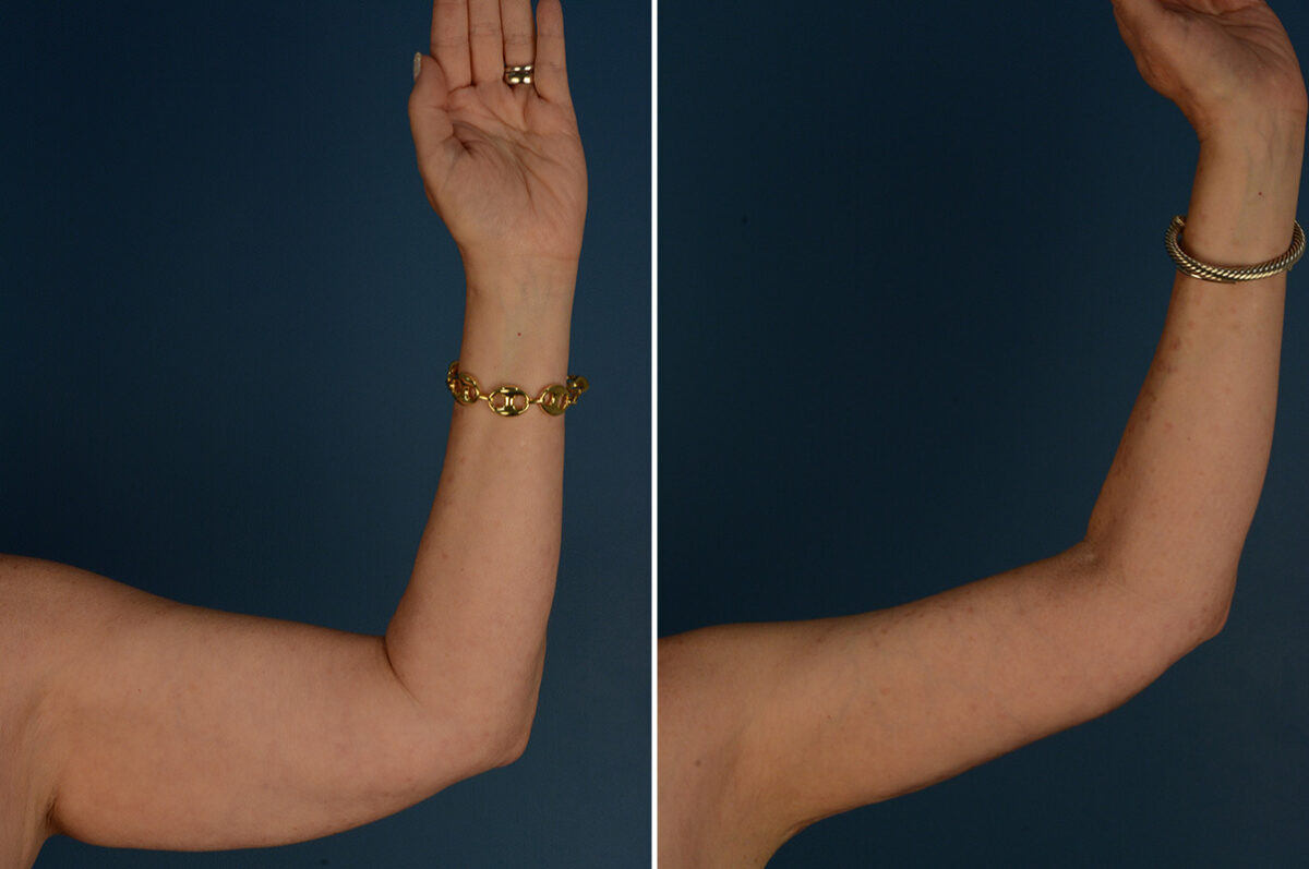 Arm Lift Before and After Photos in Naples, FL, Patient 33454