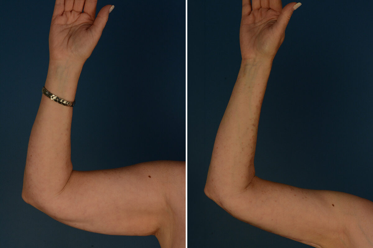 Arm Lift Before and After Photos in Naples, FL, Patient 33454