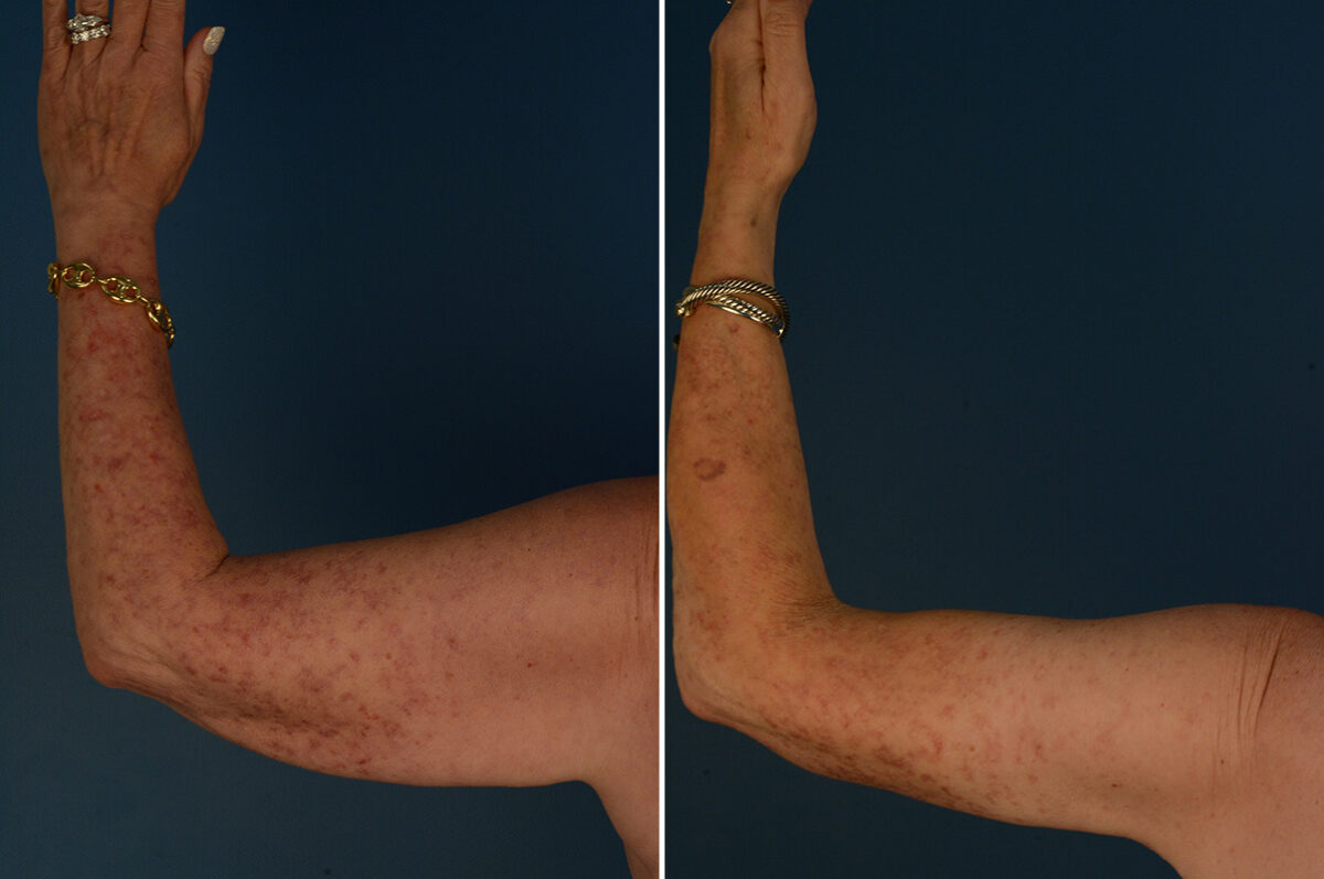 Arm Lift Before and After Photos in Naples, FL, Patient 33454