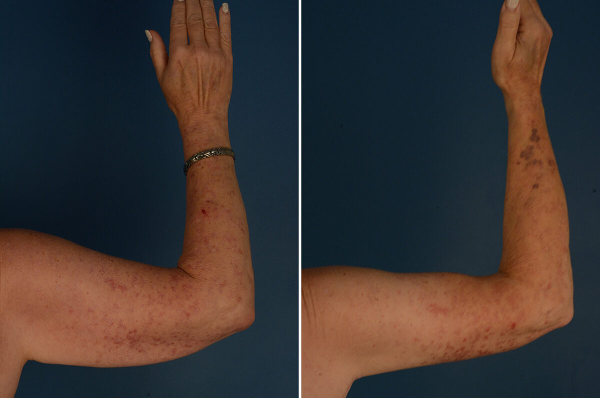 Arm Lift Before and After Photos in Naples, FL, Patient 33454