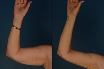 Arm Lift Before and After Photos in Naples, FL, Patient 33454