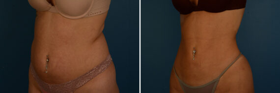 VASER® Liposuction with Renuvion Before and After Photos in Naples, FL, Patient 33517