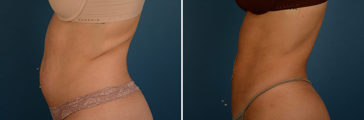 VASER® Liposuction with Renuvion Before and After Photos in Naples, FL, Patient 33517
