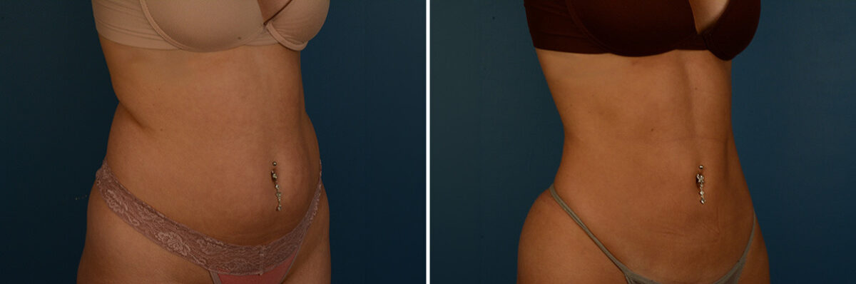 VASER® Liposuction with Renuvion Before and After Photos in Naples, FL, Patient 33517