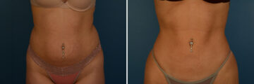 VASER® Liposuction with Renuvion Before and After Photos in Naples, FL, Patient 33517