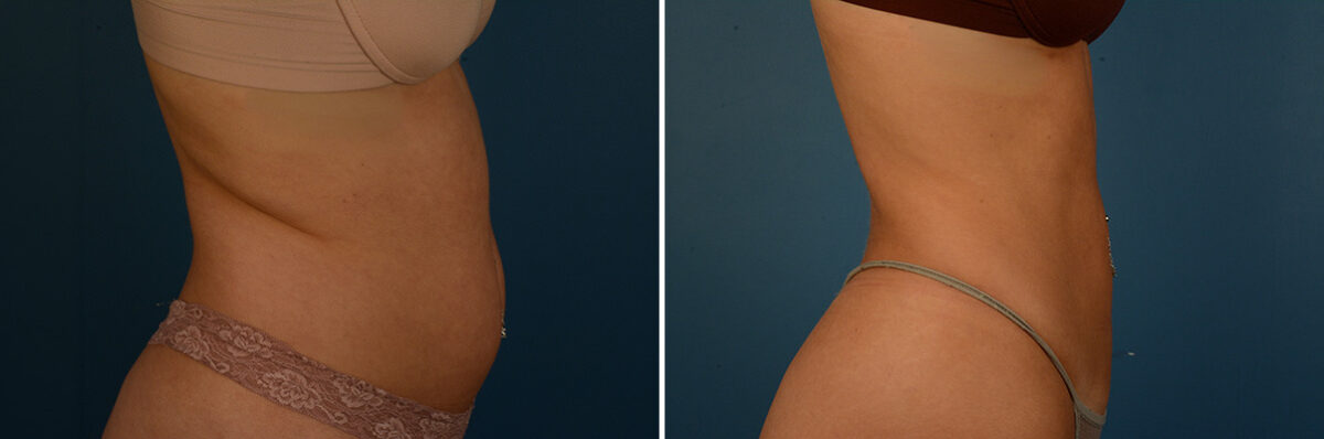 VASER® Liposuction with Renuvion Before and After Photos in Naples, FL, Patient 33517