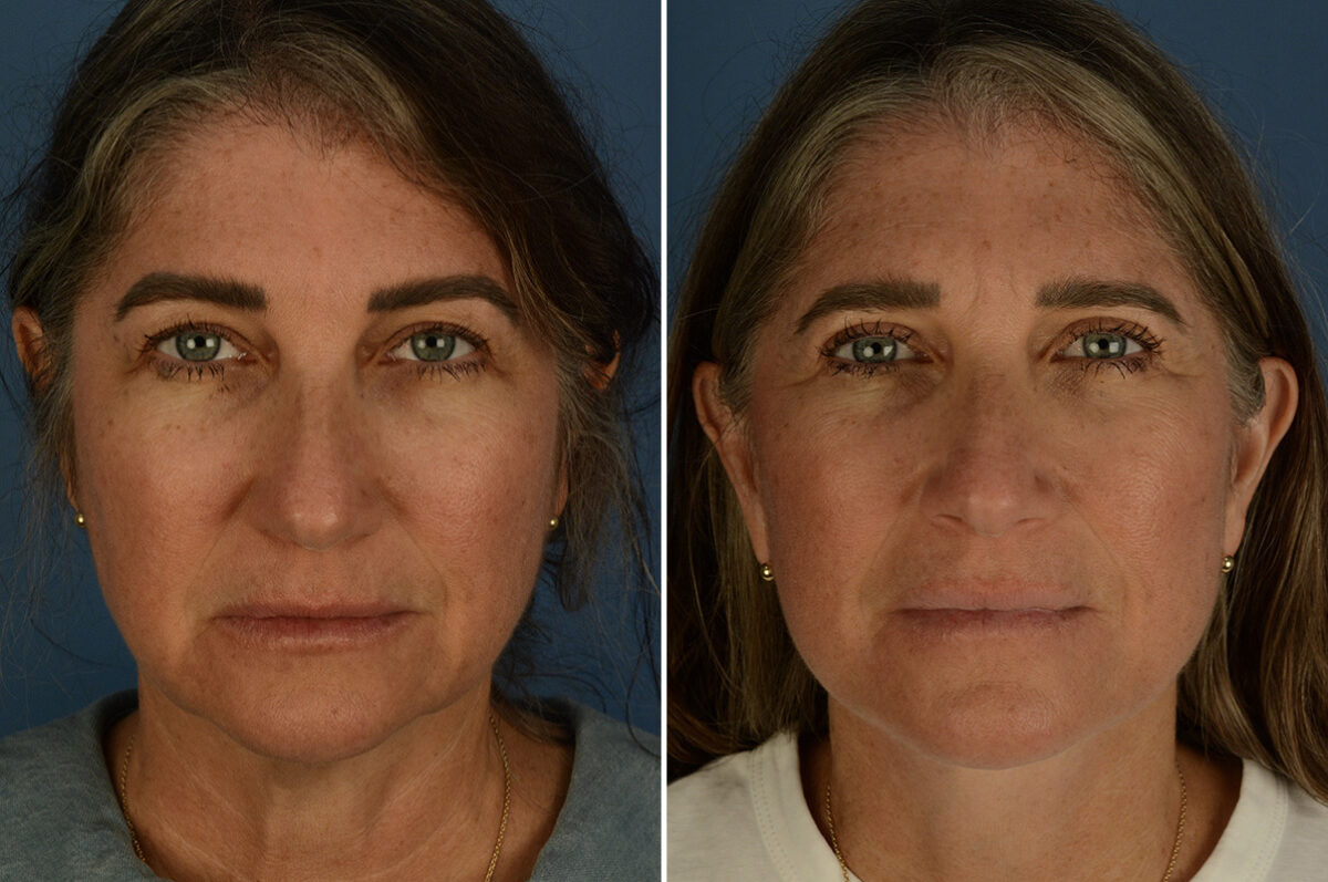 The UpLift™ Lower Face and Neck Lift Before and After Photos in Naples, FL, Patient 33544