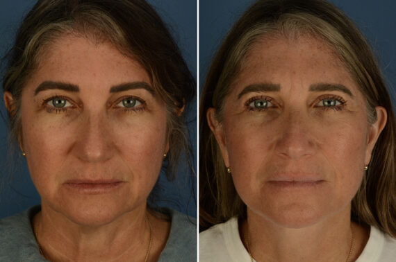 The UpLift™ Lower Face and Neck Lift Before and After Photos in Naples, FL, Patient 33544