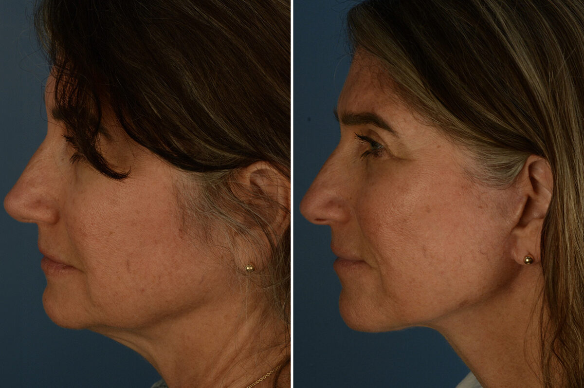The UpLift™ Lower Face and Neck Lift Before and After Photos in Naples, FL, Patient 33544