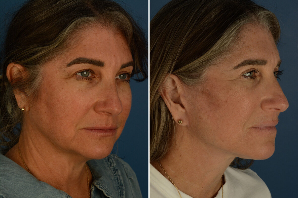 The UpLift™ Lower Face and Neck Lift Before and After Photos in Naples, FL, Patient 33544