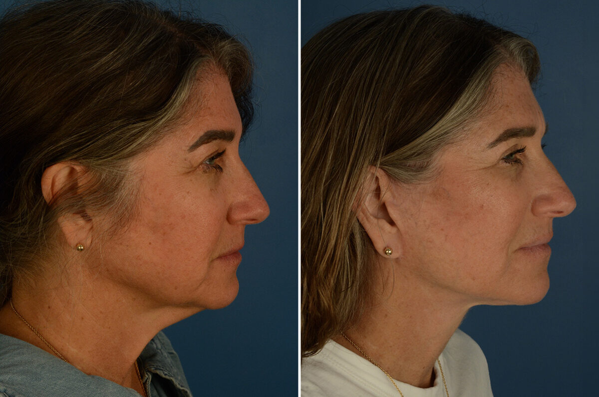 The UpLift™ Lower Face and Neck Lift Before and After Photos in Naples, FL, Patient 33544