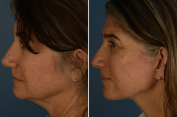 The UpLift™ Lower Face and Neck Lift Before and After Photos in Naples, FL, Patient 33544