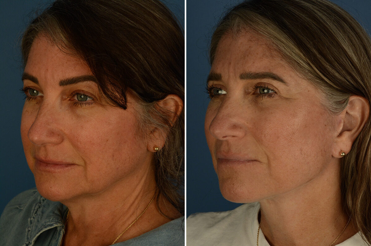 The UpLift™ Lower Face and Neck Lift Before and After Photos in Naples, FL, Patient 33544