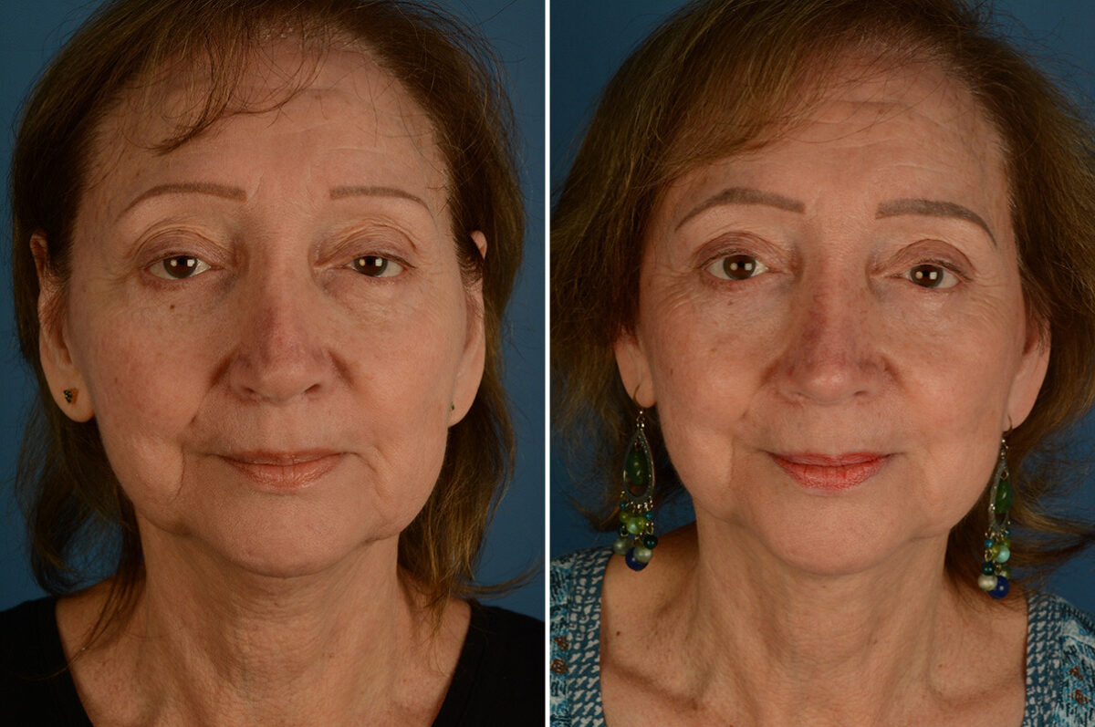 Revision Rhinoplasty Before and After Photos in Naples, FL, Patient 33588