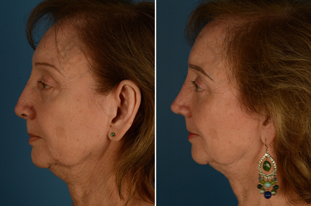 Revision Rhinoplasty Before and After Photos in Naples, FL, Patient 33588