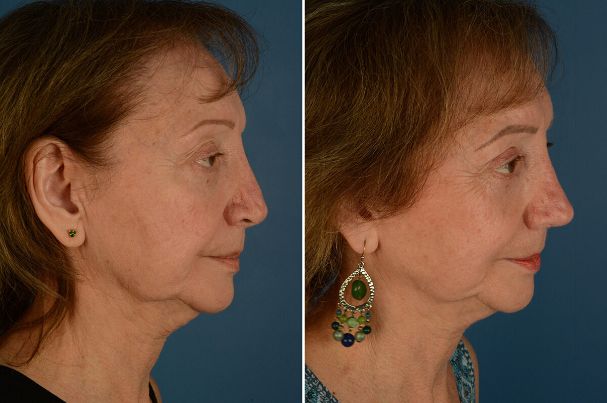 Revision Rhinoplasty Before and After Photos in Naples, FL, Patient 33588