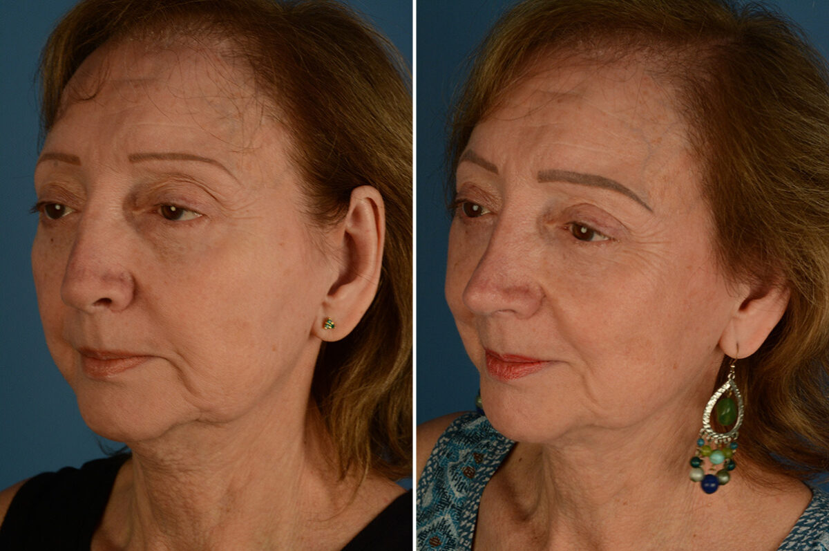 Revision Rhinoplasty Before and After Photos in Naples, FL, Patient 33588