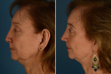 Revision Rhinoplasty Before and After Photos in Naples, FL, Patient 33588