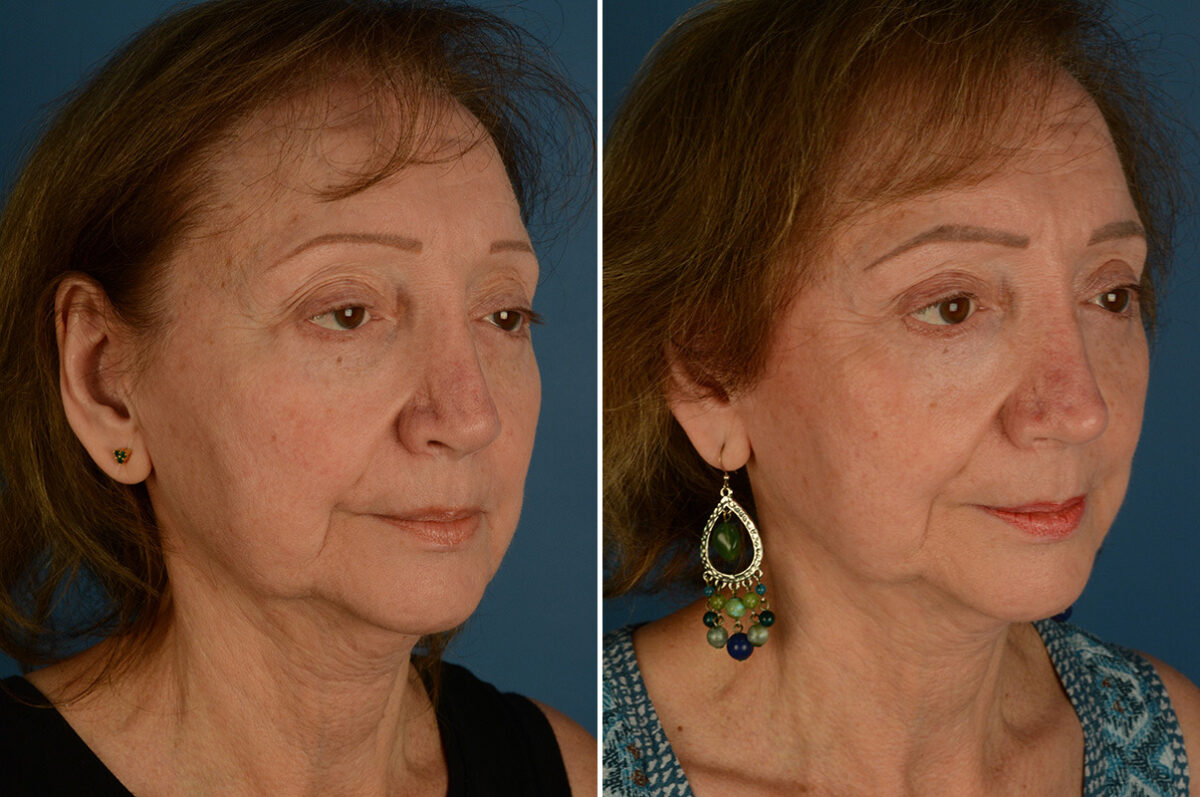 Revision Rhinoplasty Before and After Photos in Naples, FL, Patient 33588