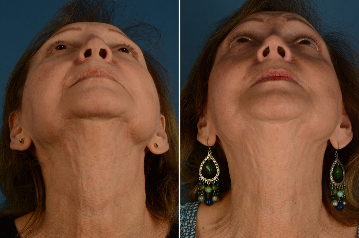 Revision Rhinoplasty Before and After Photos in Naples, FL, Patient 33588