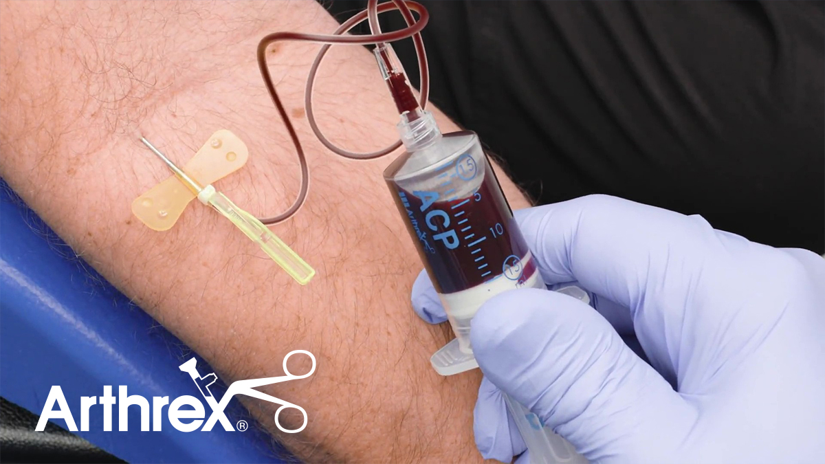 Arthrex ACP® Platelet-Rich Plasma (PRP) System: Centrifugation and PRP Separation