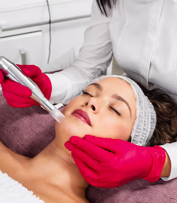 Clinician performing PRP with microneedling on a woman's cheek to support collagen production and skin rejuvenation.