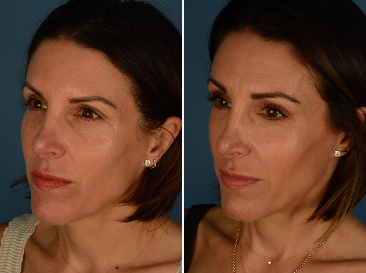 Eyebrow & Forehead Before and After Photos in Naples, FL, Patient 33973