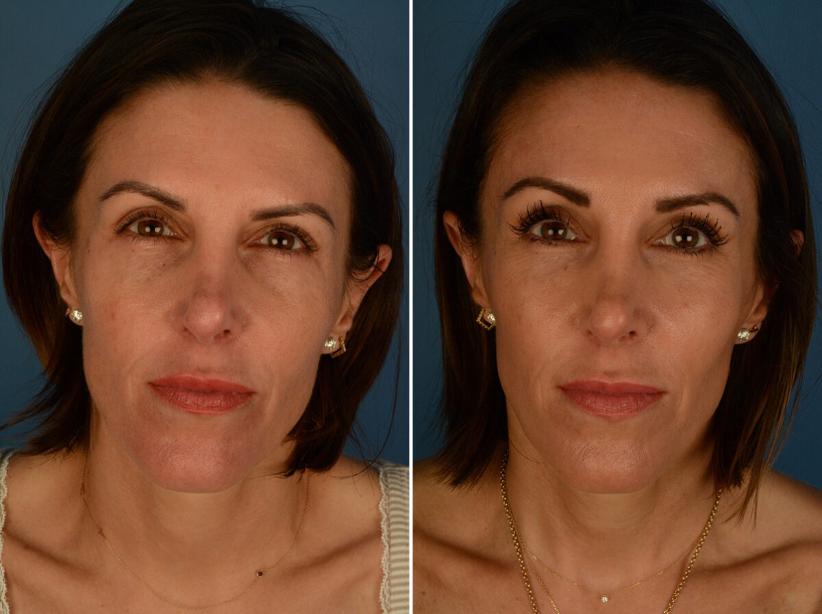 Eyebrow & Forehead Before and After Photos in Naples, FL, Patient 33973