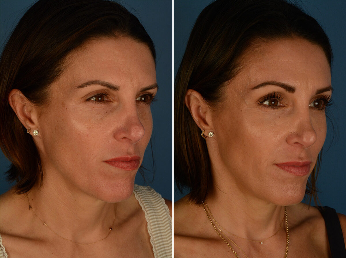 Eyebrow & Forehead Before and After Photos in Naples, FL, Patient 33973