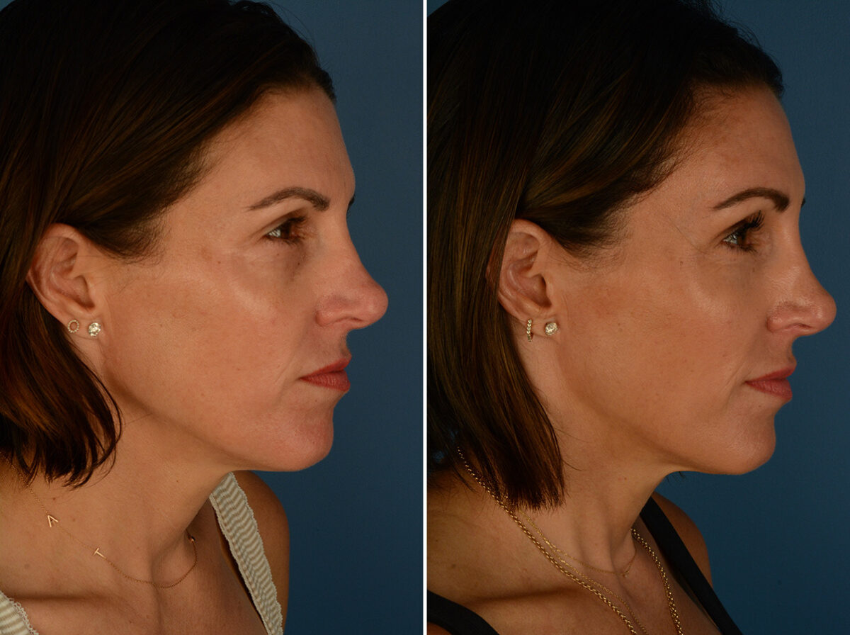 Eyebrow & Forehead Before and After Photos in Naples, FL, Patient 33973