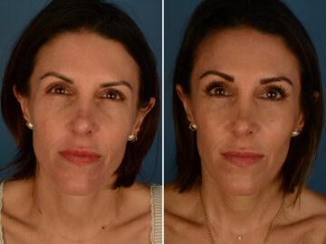 Eyebrow & Forehead Before and After Photos in Naples, FL, Patient 33973