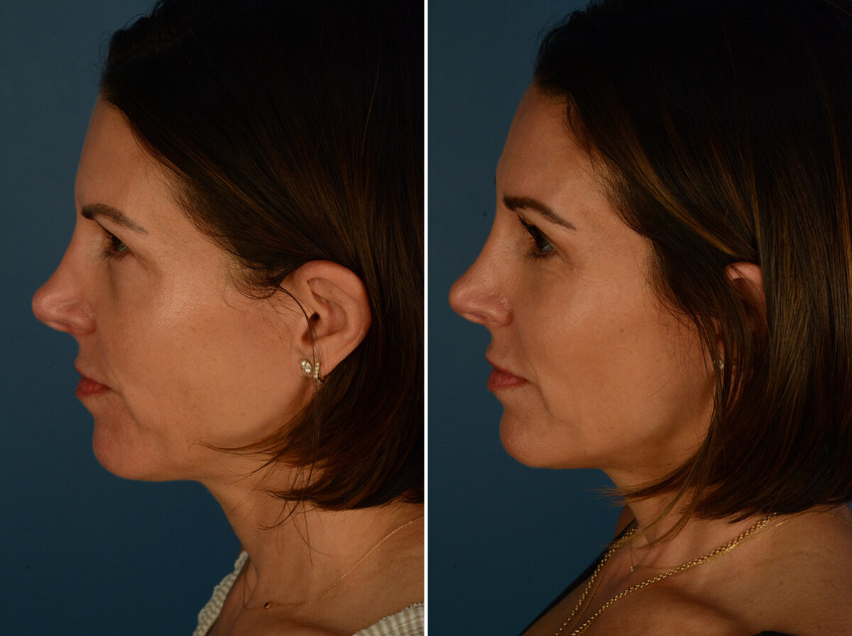 Eyebrow & Forehead Before and After Photos in Naples, FL, Patient 33973