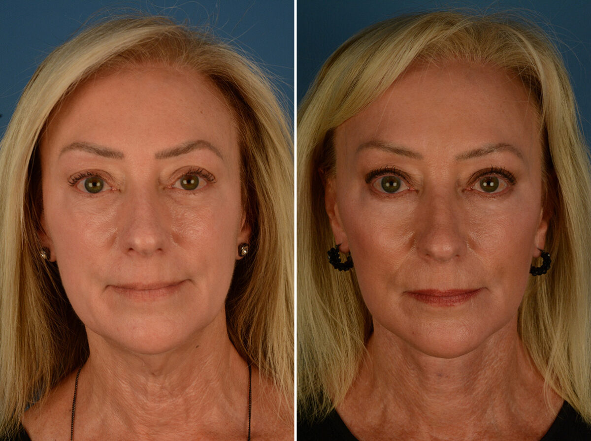 The UpLift™ Lower Face and Neck Lift Before and After Photos in Naples, FL, Patient 34010