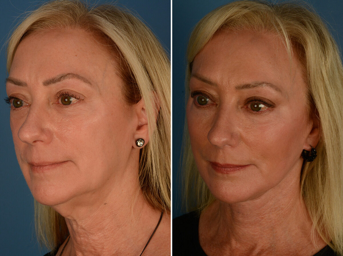 The UpLift™ Lower Face and Neck Lift Before and After Photos in Naples, FL, Patient 34010