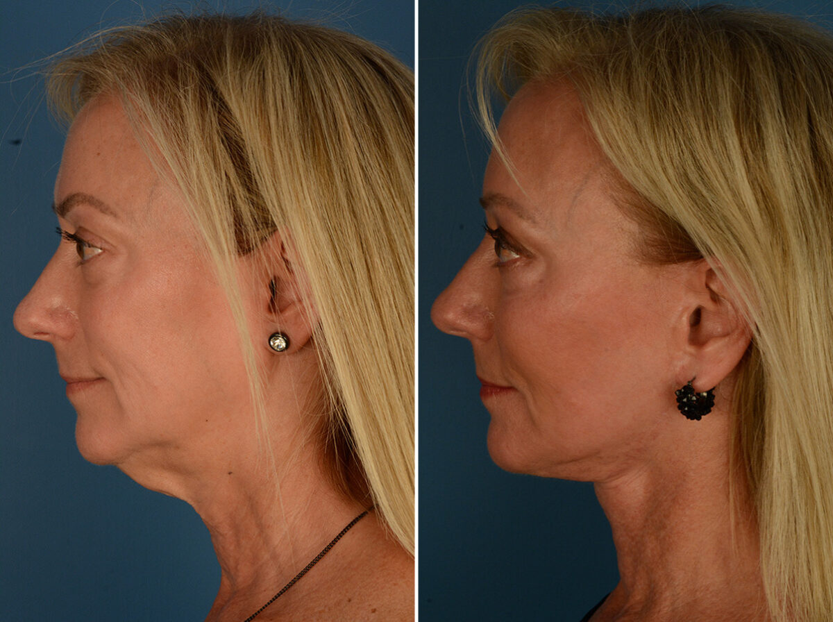 The UpLift™ Lower Face and Neck Lift Before and After Photos in Naples, FL, Patient 34010