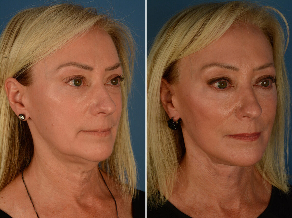 The UpLift™ Lower Face and Neck Lift Before and After Photos in Naples, FL, Patient 34010