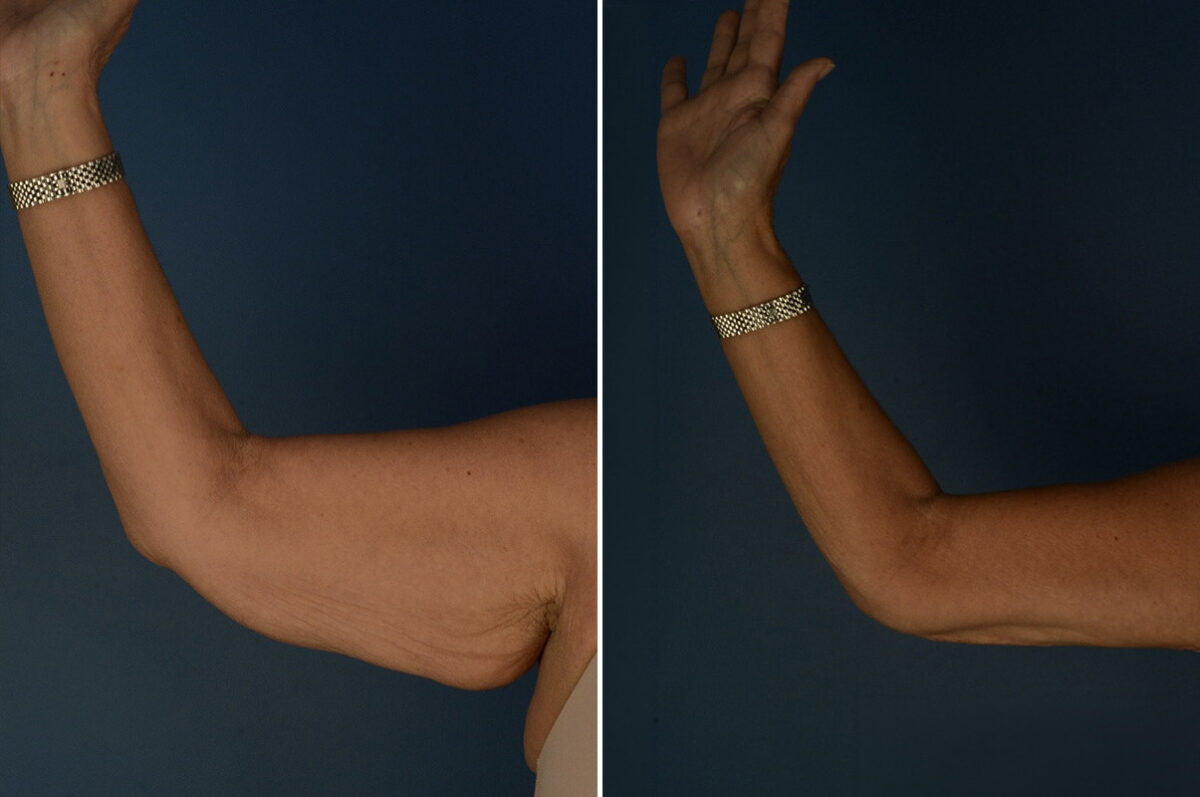 Arm Lift Before and After Photos in Naples, FL, Patient 34046