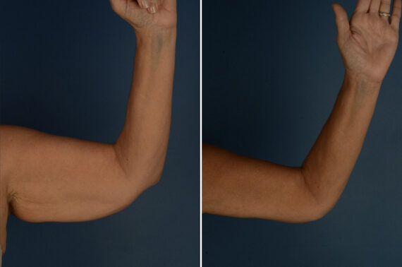 Arm Lift Before and After Photos in Naples, FL, Patient 34046