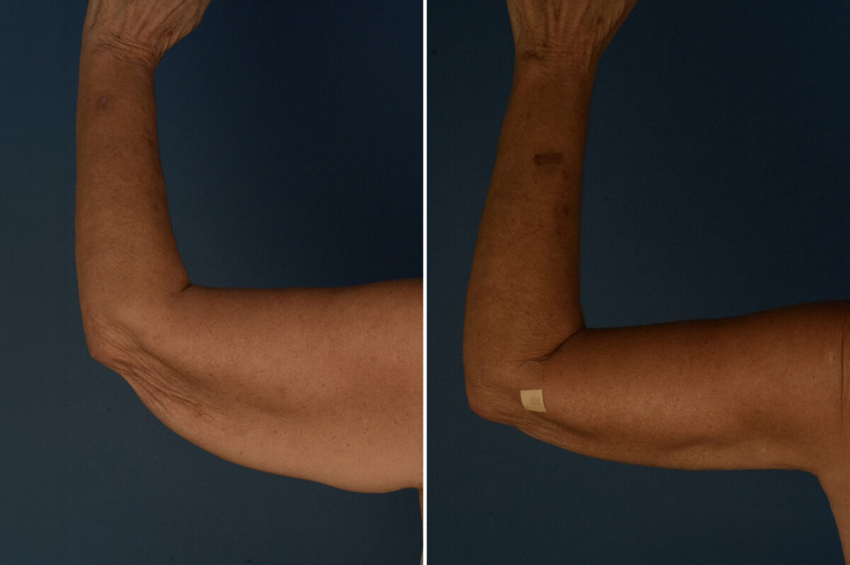 Arm Lift Before and After Photos in Naples, FL, Patient 34046