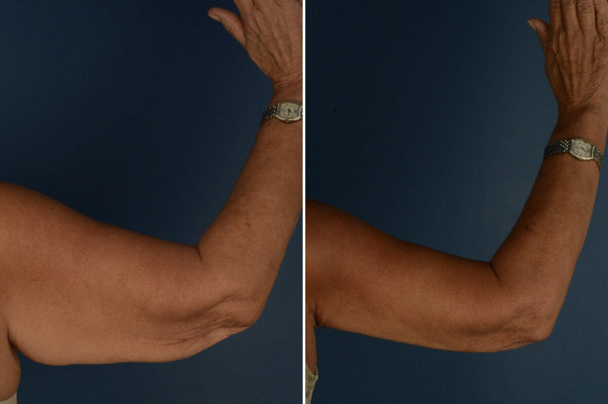 Arm Lift Before and After Photos in Naples, FL, Patient 34046