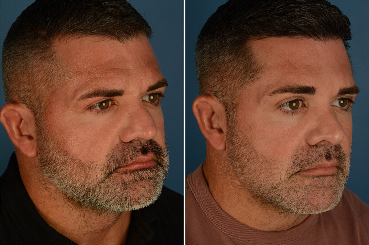 Rhinoplasty Before and After Photos in Naples, FL, Patient 34133