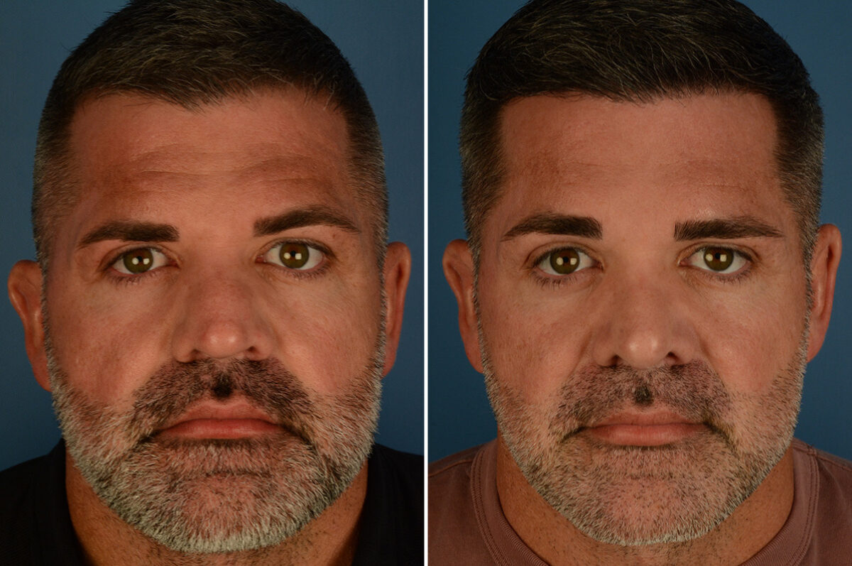 Rhinoplasty Before and After Photos in Naples, FL, Patient 34133