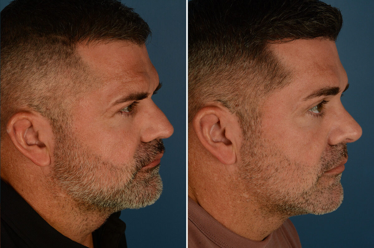 Rhinoplasty Before and After Photos in Naples, FL, Patient 34133