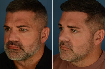Rhinoplasty Before and After Photos in Naples, FL, Patient 34133