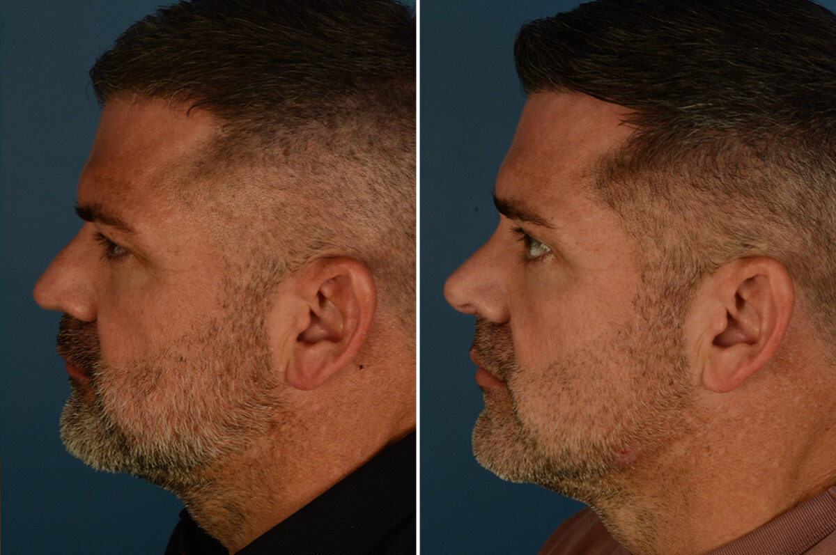 Rhinoplasty Before and After Photos in Naples, FL, Patient 34133
