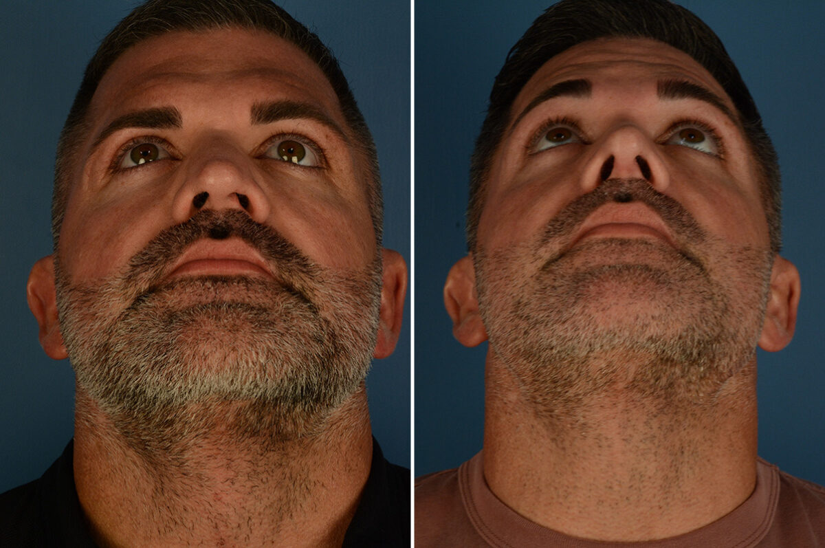 Rhinoplasty Before and After Photos in Naples, FL, Patient 34133